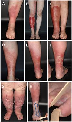 Intracellular Streptococcal Uptake and Persistence: A Potential Cause of Erysipelas Recurrence